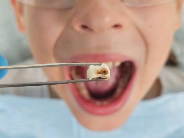 Best Emergency Tooth Extraction in Ampere North, NJ